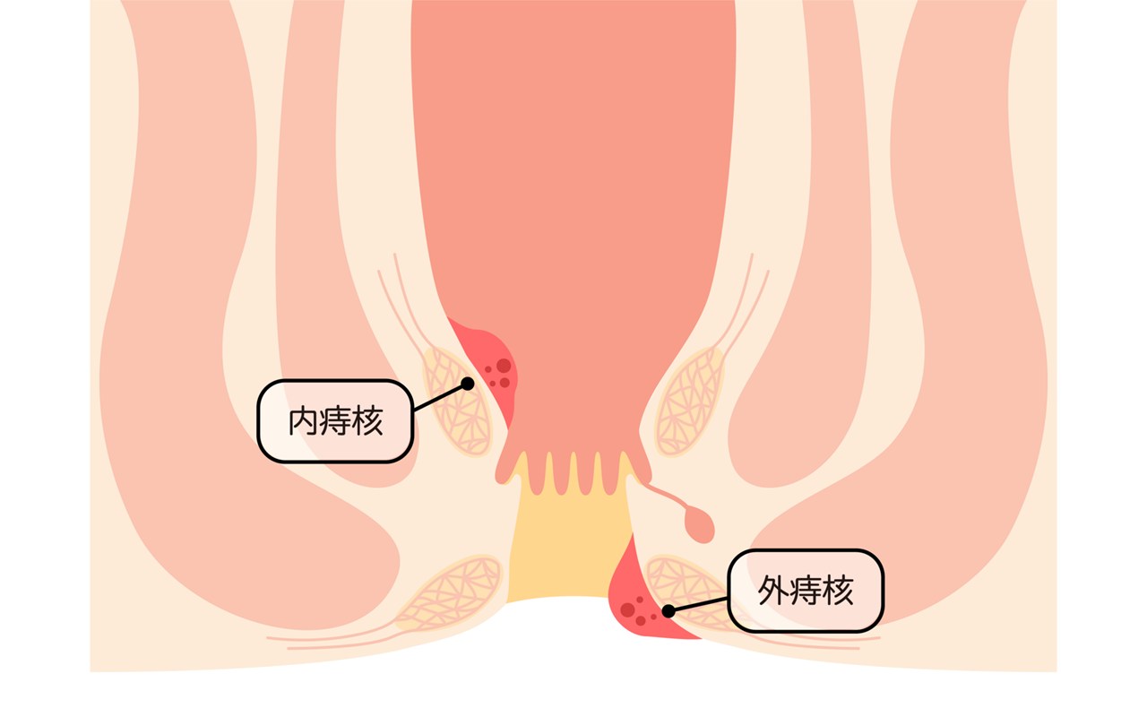 切れ痔（裂肛）