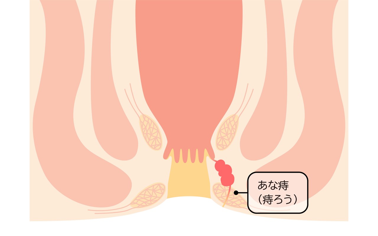 痔ろう（あな痔）