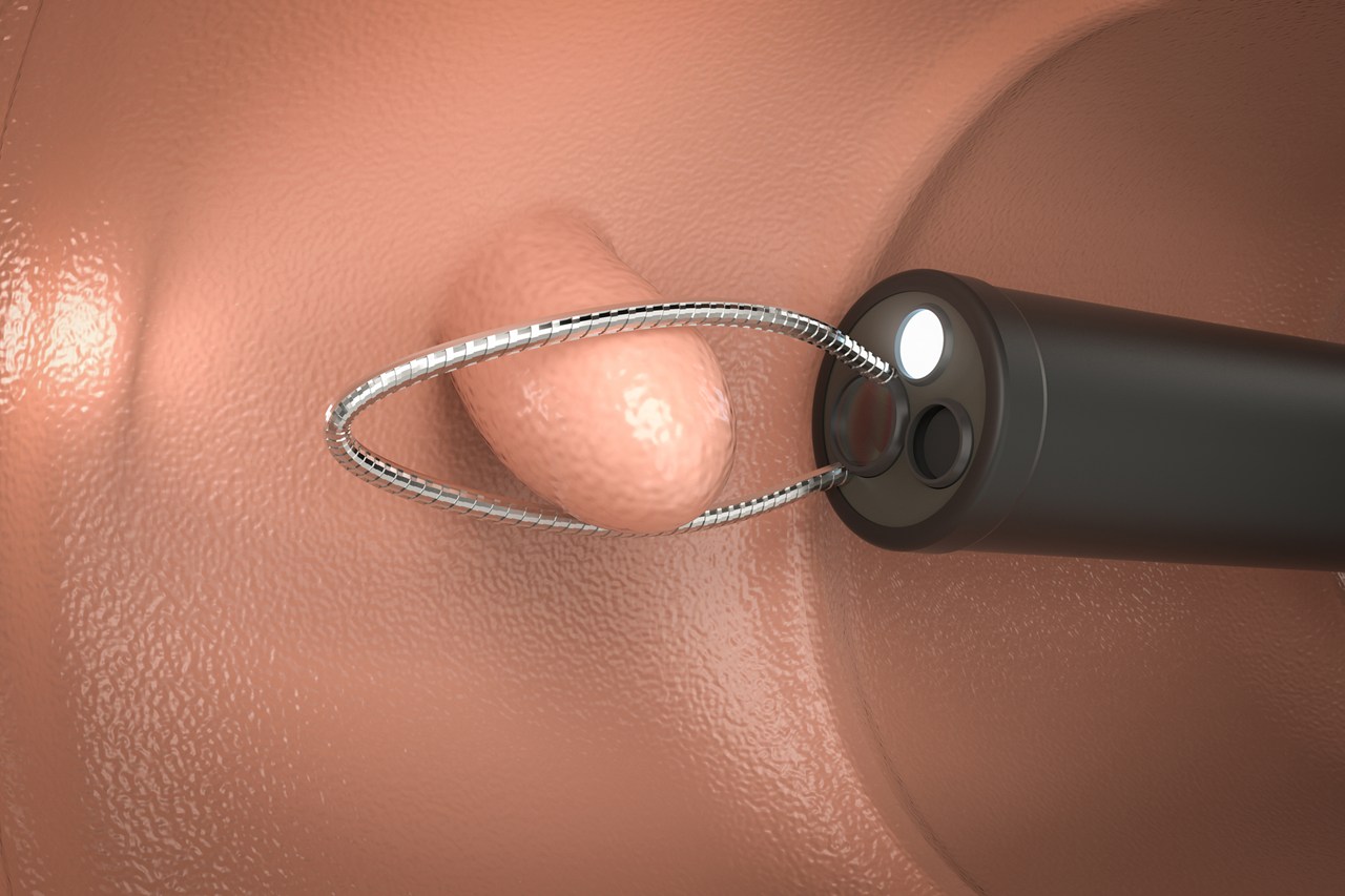 大腸ポリープ切除について