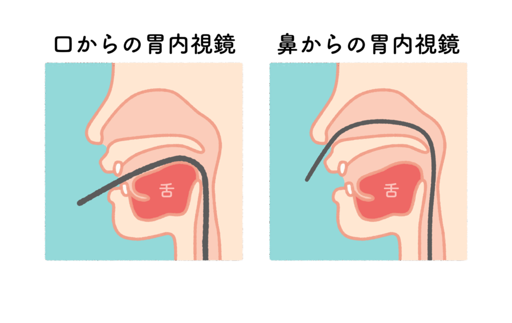 胃カメラは鼻と口どっちが楽？